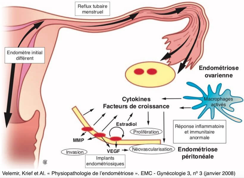 Physiopathologie de l’endométriose