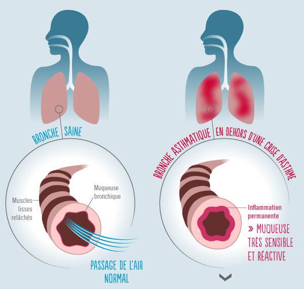 Vue globale mecanisme asthme - Ameli.fr
